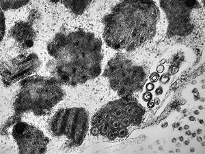 F,31y. | mast cell - granules with scroll-like formations - n. suralis, demyelinating neuropathy